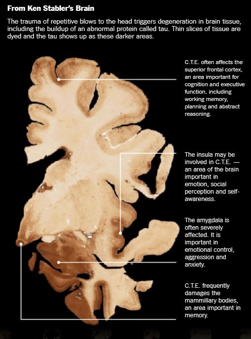 111 NFL Brains Examined. 110 Have Chronic Traumatic Encephalopathy